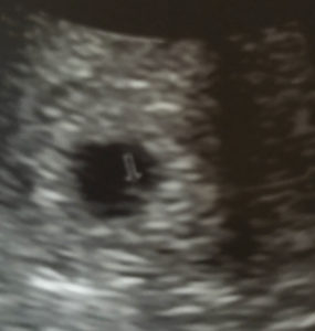 Clarksville-TN-Essure-reversal-intrauterine-pregnancy