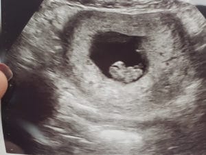 9-weeks-pregnant-after-tubal-clip-reversal-KY