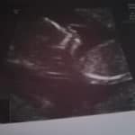 22-weeks=pregnant-with-essure-reversal-baby