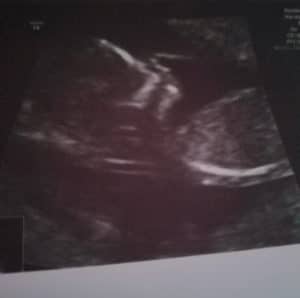 22-weeks=pregnant-with-essure-reversal-baby