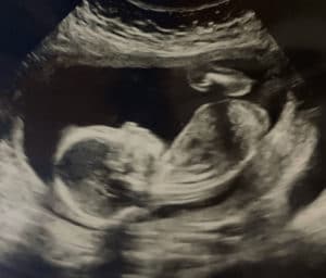 20-weeks-pregnant-after-surgery-to-reverse-tubal-ligation