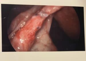 pictures-of-fallopian-tubes-after-tubal-reversal-surgery