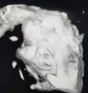 Essure-reversal-baby-due-by-csarean-soon
