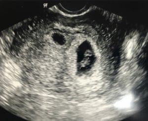 having-twins-after-Essure-reversal