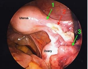 can-fallopian-tube-coagulation-be-reversed