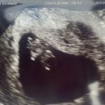 8-weeks-pregnant-reversal-of-tubal-bands