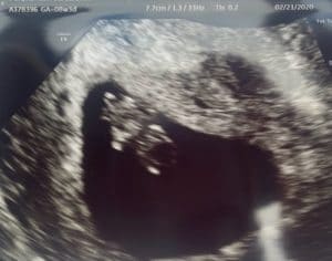 8-weeks-pregnant-reversal-of-tubal-bands