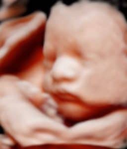 pregnant-two-months-after-tubal-reversal-surgery-with-dr-monteith