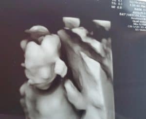 22-weeks-pregnant-after-tubal-reversal-surgery