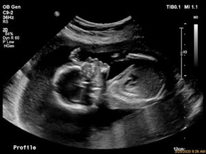 tubal-reversal-baby-number-two