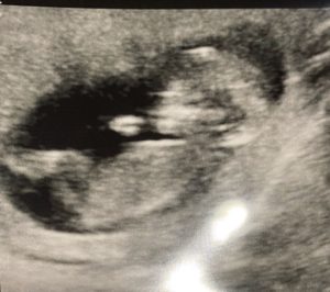 having-a-boy-after-reversing-tubal-clip-tubal-ligation