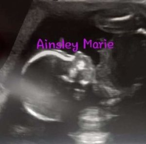 27-weeks-pregnant-after-reversing-tubal-bands