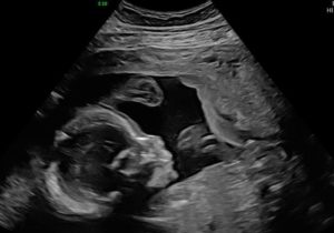 baby-born-one-year-after-reversal-surgery