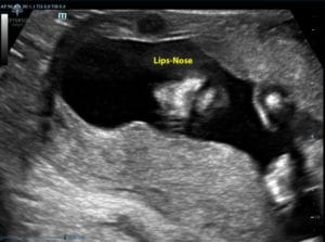 20-week-essure-reversal-baby-from-palmyra-va