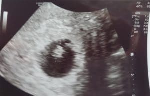 tubal-reversal-walla-walla-wa