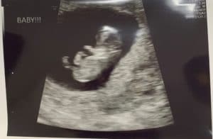 tubal-reversal-rings-10-weeks