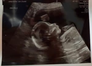 only-100-days-away-from-meeting-tubal-reversal-baby
