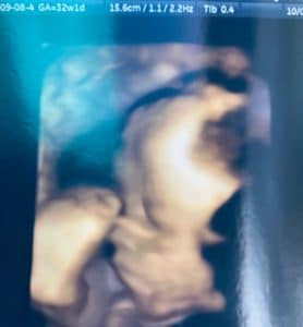 little-colton-will-be-here-soon-after-reversal-surgery