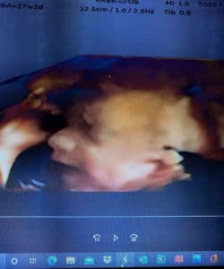 Essure-reversal-baby-from-williamsburg-kentucky