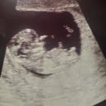 12-weeks-pregnant-after-tuabl-reversal-walla-walla-washington
