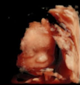 four-chemical-pregnancies-now-with-keeper