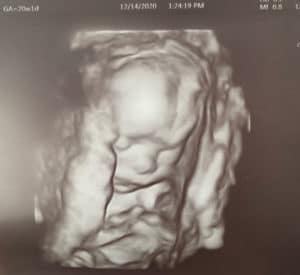 halfway-there-at-20-weeks-of-pregnancy-after-tubal-reversal