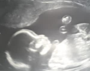 reversing-tied-cut-tubal-ligation