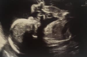 tubal-reversal-surgery-was-worth-every-penny