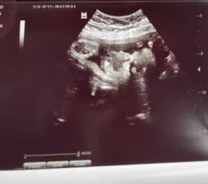 31-weeks-pregnant-after-reversing-tied-and-cut-tubes