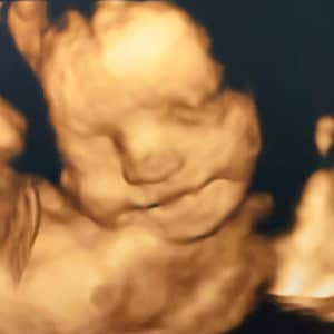 tubal-reversal-3d-ultrasound
