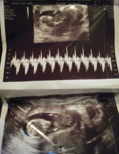 second-pregnancy-after-tubal-reversal-surgery