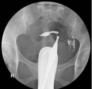 hsg-xray-can-diagnose-tubal-blockage-from-scar-tissue