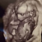 18-weeks-pregnant-tubal-reversal-tubal-clips