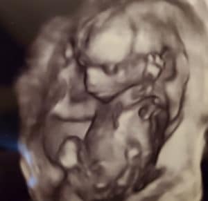 18-weeks-pregnant-tubal-reversal-tubal-clips