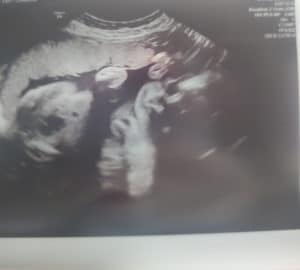 tubal-reversal-baby-from-Crawfordville