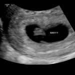 two-quick-pregnancies-after-tubal-reversal
