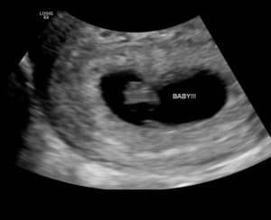 two-quick-pregnancies-after-tubal-reversal