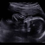 tubal-reversal-baby-has-anatomy-ultrasound