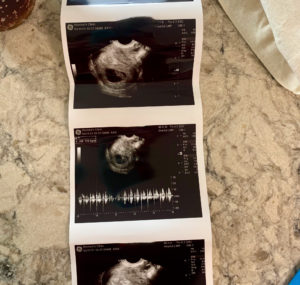 tubal-reversal-baby-from-traverse-city-michagan