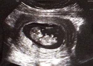 reversing-burned-tubal-ligation-kansas-couple-success