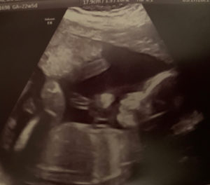 23-weeks-pregnant-after-reversing-tubal-bands
