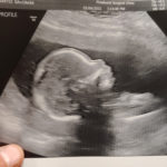 22-weeks-pregnant-Cameron-NC-burned-tube-reversal