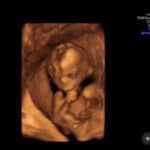 18-weeks-gestation-with-Essure-reversal-baby