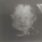 34-week-gestation-Essure-reversal-baby-from-Catlettsburg-KY