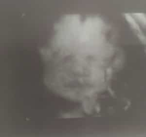 34-week-gestation-Essure-reversal-baby-from-Catlettsburg-KY