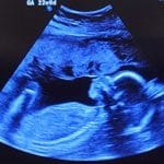 meet-a-22-week-gestation-Essure-reversal-baby-from-harris