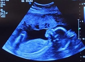 meet-a-22-week-gestation-Essure-reversal-baby-from-harris