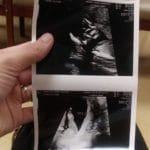ultrasound-photo-baby-girl-after-tubal-reversal-surgery