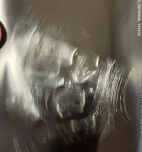 tubal-reversal-surgery-worked