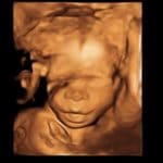 ultrasound-of-baby-after-reversing-burned-tubal-ligation